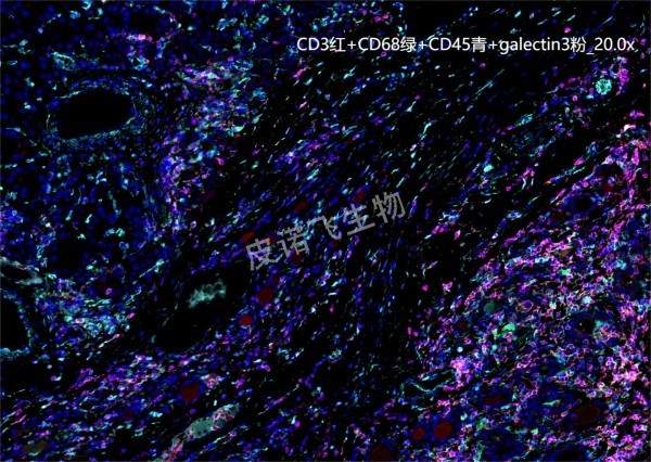 CD3紅+CD68綠+CD45青+galectin3粉 腫瘤