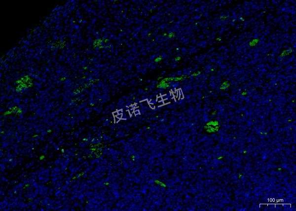 CD4綠 腫瘤