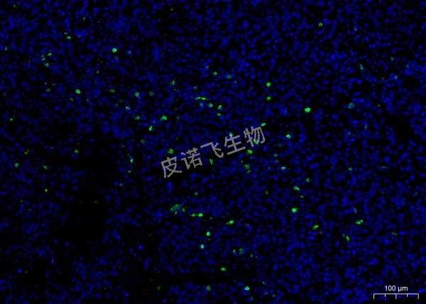 CD8綠 腫瘤
