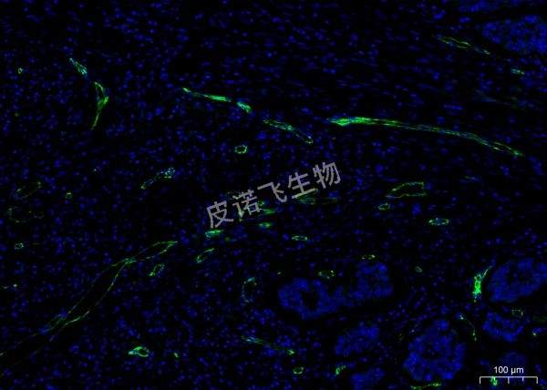 CD31綠 腫瘤
